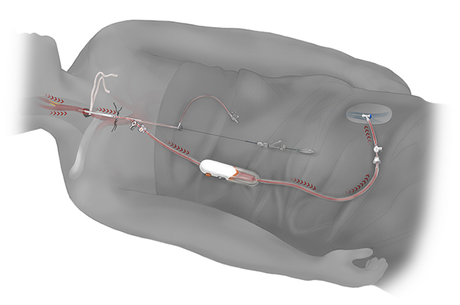 TransCarotid Artery Revascularizations (TCAR)