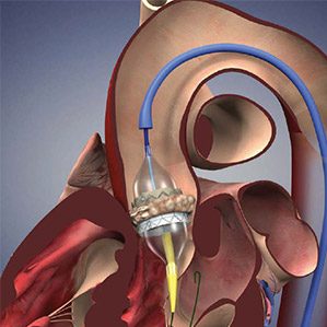 Minimally Invasive Aortic Valve Replacement