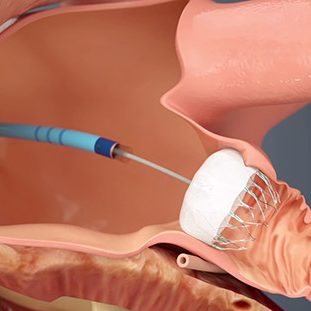 Watchman Implant