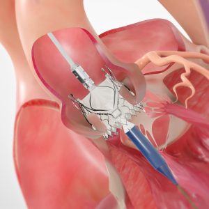 Trilogy™ Transcatheter Heart Valve System for Aortic Valve Regurgitation